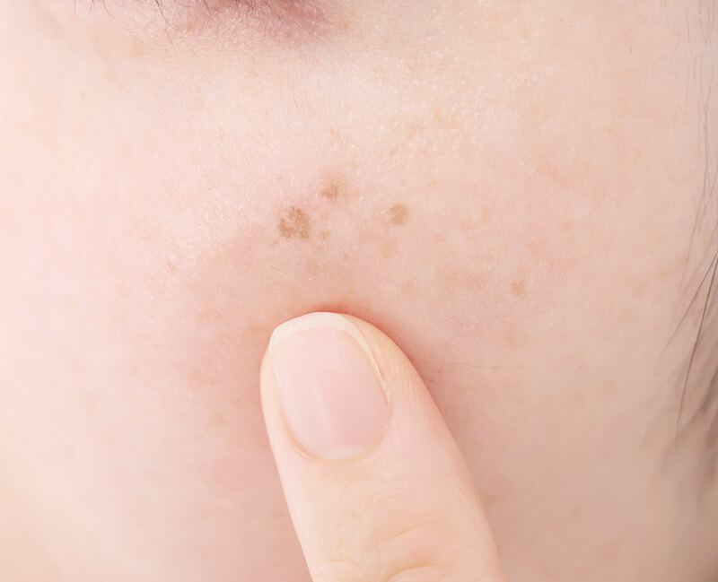 シミ取り・肝斑