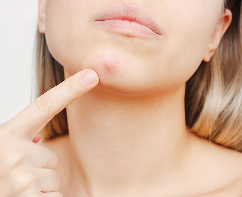 ニキビ・ニキビ跡