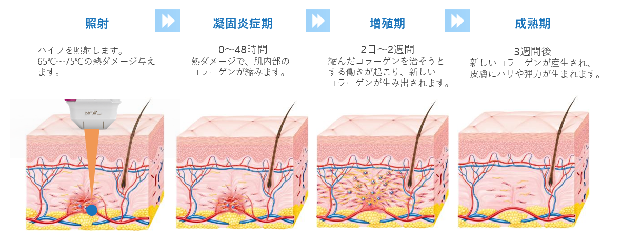 ウルトラフォーマMPT照射後にシワ・たるみが改善する仕組み