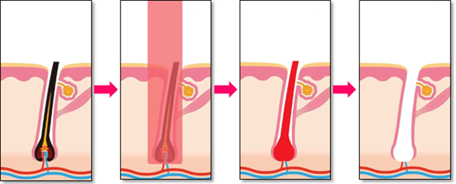 医療レーザー脱毛の仕組み