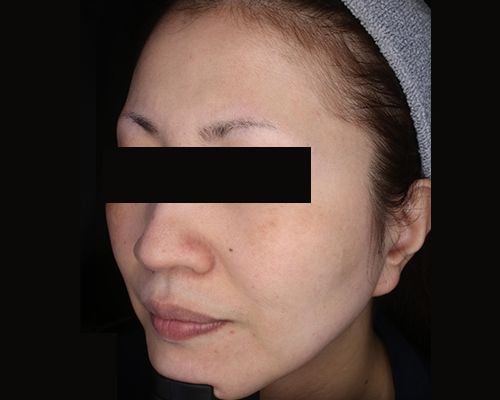 40代（施術後）