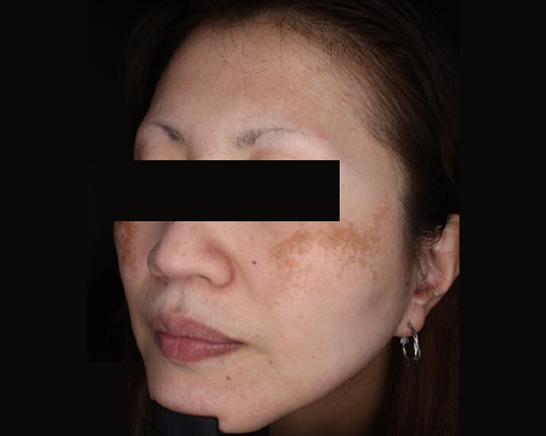 40代（施術前）