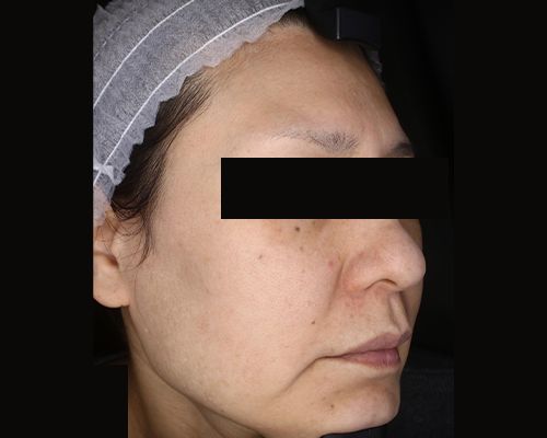 40代（施術後）