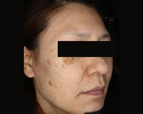 40代（施術後）