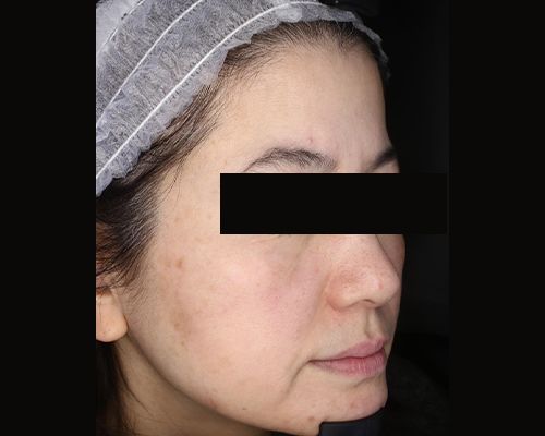 40代（施術後）