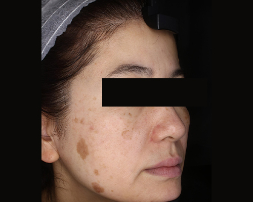 40代（施術前）