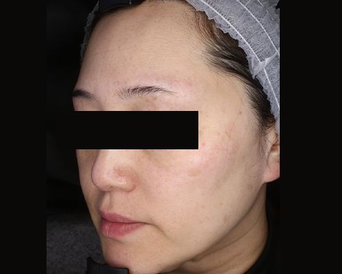 50代（施術後）