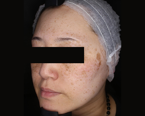 50代（施術前）