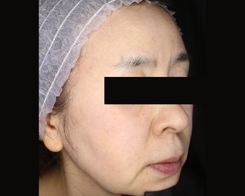 50代（施術後）