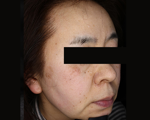 50代（施術前）