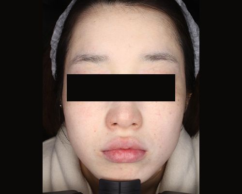 20代（施術後）