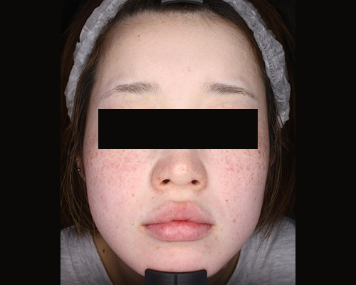 20代（施術前）