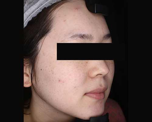 20代（施術前）