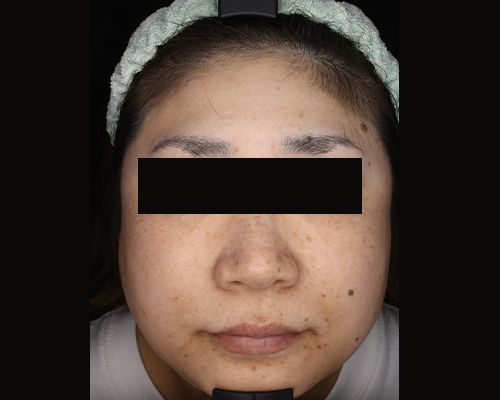 40代（施術後）