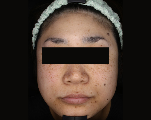 40代（施術前）