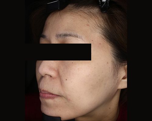 40代（施術後）