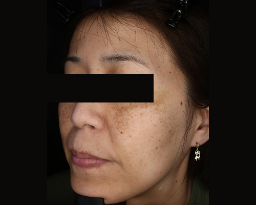 40代（施術前）