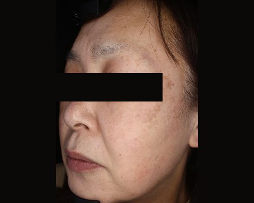 60代（施術後）