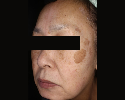 60代（施術前）