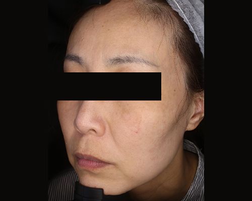 40代（施術後）