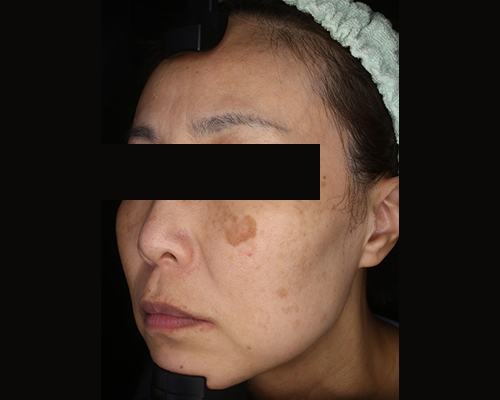 40代（施術前）