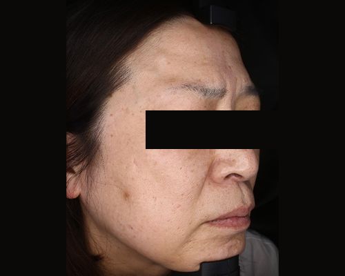 40代（施術後）