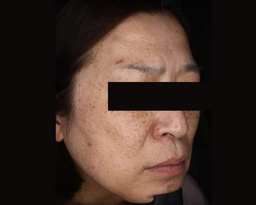 40代（施術前）