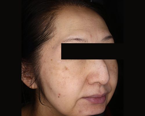 50代（施術後）