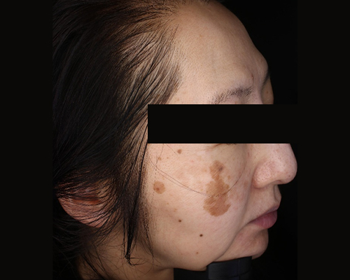 50代（施術前）