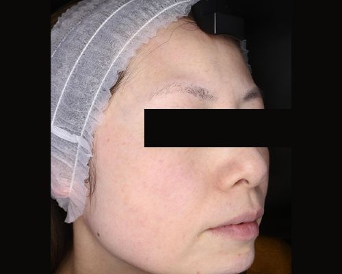 40代（施術後）