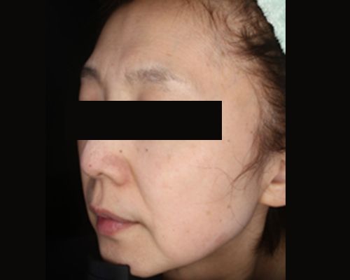 50代（施術後）