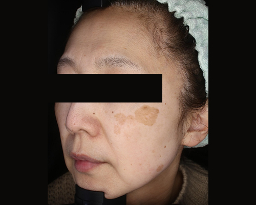 50代（施術前）