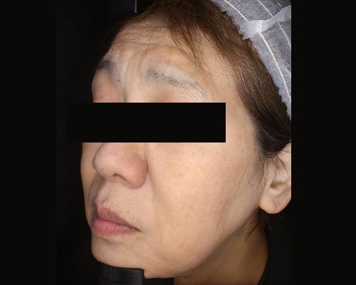 50代（施術後）