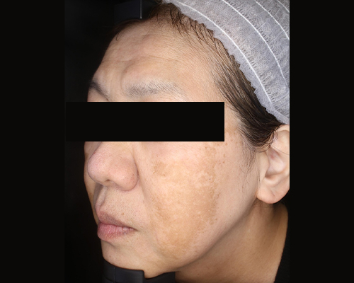 50代（施術前）